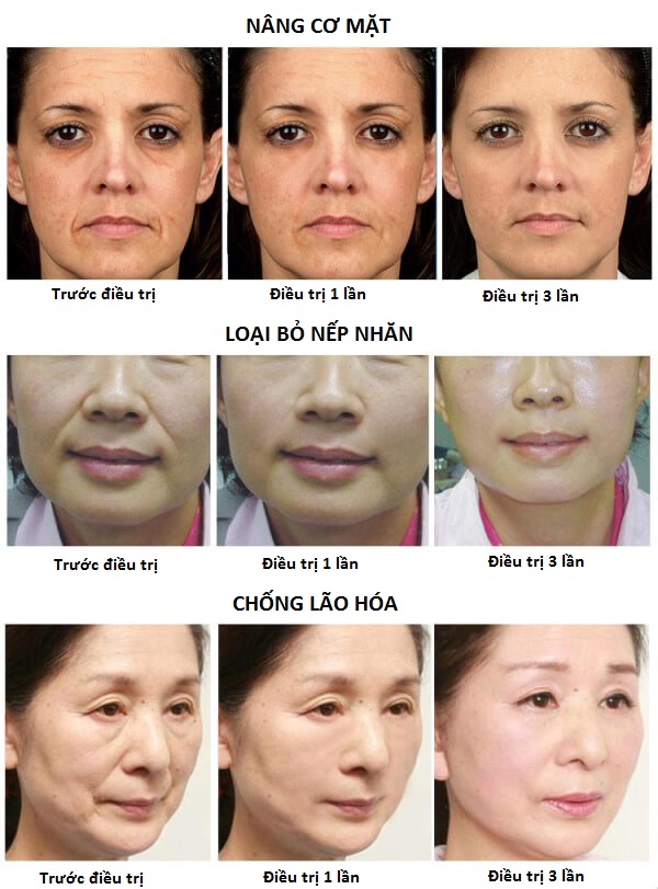 có nên nâng cơ mặt bằng hifu may tre hoa da.jpg (122 KB)